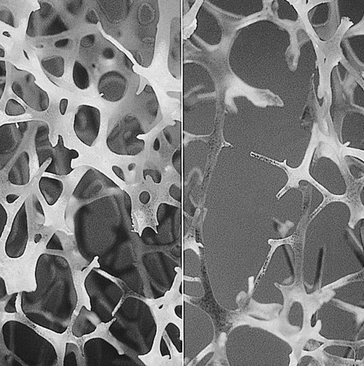 Stem Cell Therapy For Osteoporosis Gowing Life